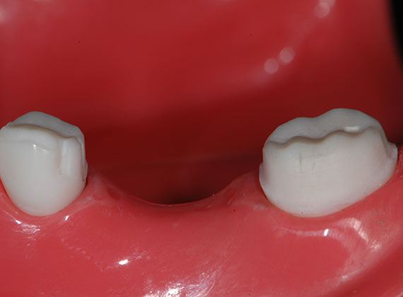 下顎小臼歯4/5冠を含む3本ブリッジの形成