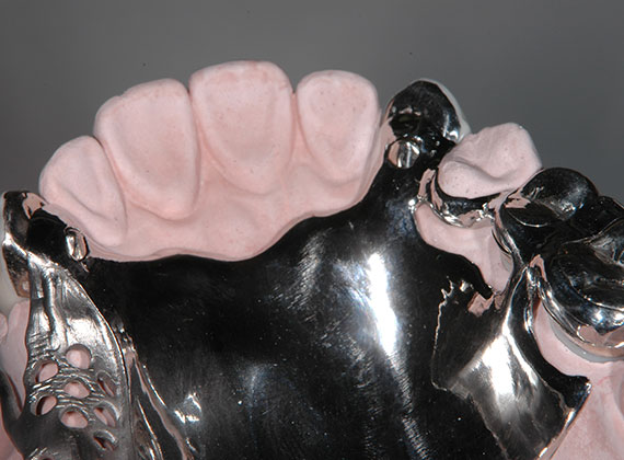 鉤歯のデザインを考慮した冠形態