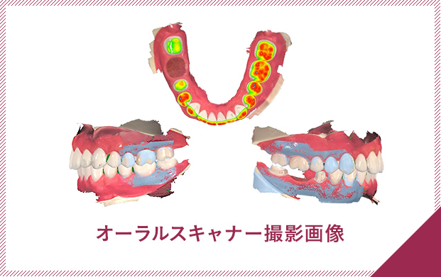 オーラルスキャナー撮影画像